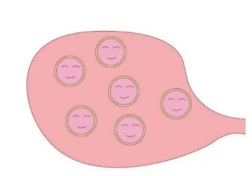 子宫肌瘤癌变会转变为巧克力囊肿吗？